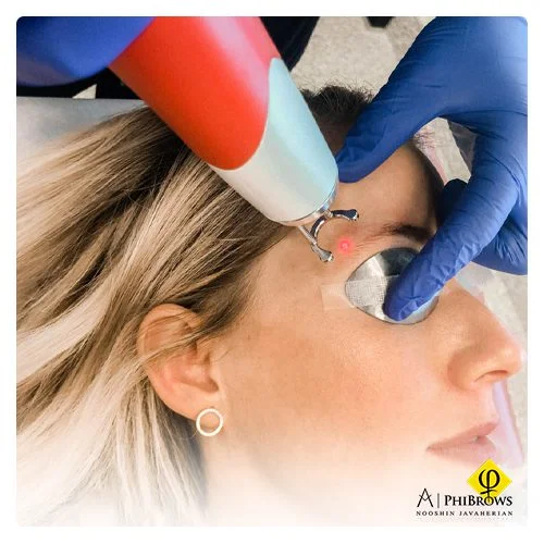 Microblading removal